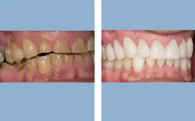 Full mouth rehabilitation before and after result 3 - performed in India, IndiCure patient
