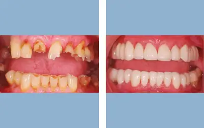 Full mouth rehabilitation before and after result 4 - performed in India, IndiCure patient