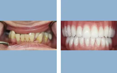 Full mouth rehabilitation before and after result 5 - performed in India, IndiCure patient
