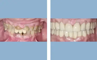 Full mouth rehabilitation before and after result 6 - performed in India, IndiCure patient