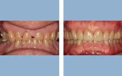 Full mouth rehabilitation before and after result 7 - performed in India, IndiCure patient