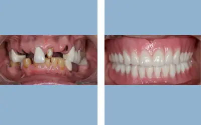 Full mouth rehabilitation before and after result 8 - performed in India, IndiCure patient