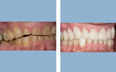 Full mouth rehabilitation before and after result 9 - performed in India, IndiCure patient