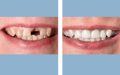 Root canal treatment before and after result 1 - endodontic treatment in India, IndiCure patient