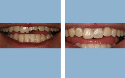 Root canal treatment before and after result 2 - endodontic treatment in India, IndiCure patient
