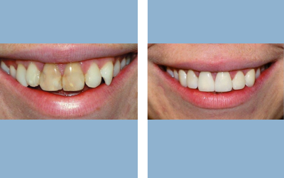 Root canal treatment before and after result 3 - endodontic treatment in India, IndiCure patient
