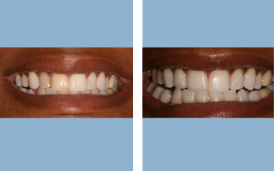 Root canal treatment before and after result 4 - endodontic treatment in India, IndiCure patient