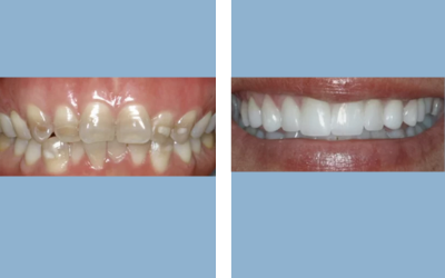 Root canal treatment before and after result 5 - endodontic treatment in India, IndiCure patient