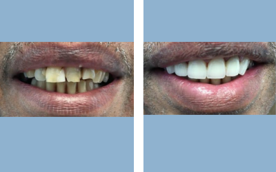 Root canal treatment before and after result 6 - endodontic treatment in India, IndiCure patient