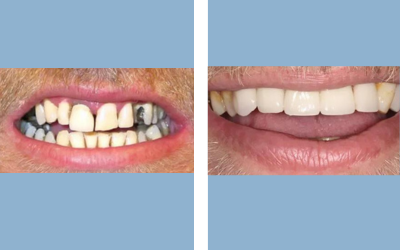 Root canal treatment before and after result 7 - endodontic treatment in India, IndiCure patient