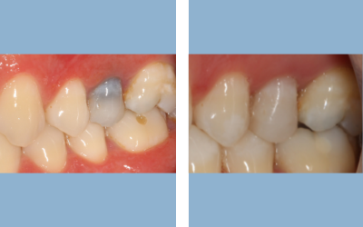 Root canal treatment before and after result 8 - endodontic treatment in India, IndiCure patient