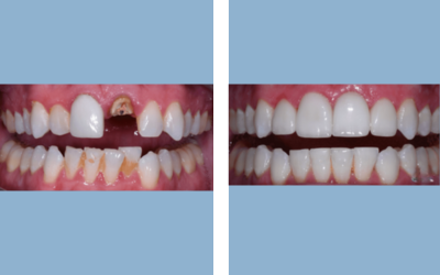 Root canal treatment before and after result 9 - endodontic treatment in India, IndiCure patient