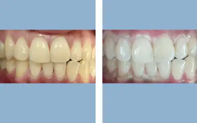 Teeth whitening before and after result 1 - dental treatment in India, IndiCure patient