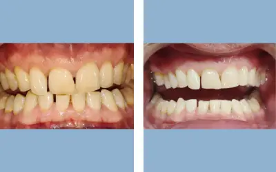 Teeth whitening before and after result 10 - dental treatment in India, IndiCure patient