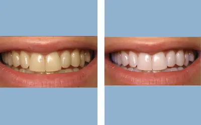 Teeth whitening before and after result 2 - dental treatment in India, IndiCure patient