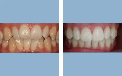 Teeth whitening before and after result 3 - dental treatment in India, IndiCure patient