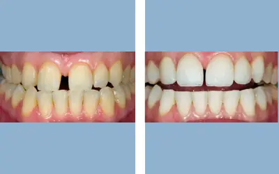 Teeth whitening before and after result 4 - dental treatment in India, IndiCure patient