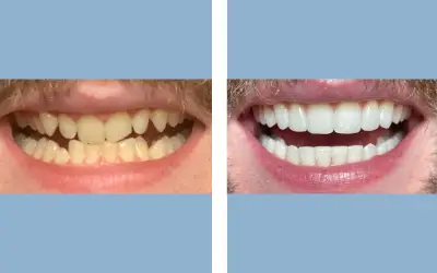 Teeth whitening before and after result 5 - dental treatment in India, IndiCure patient