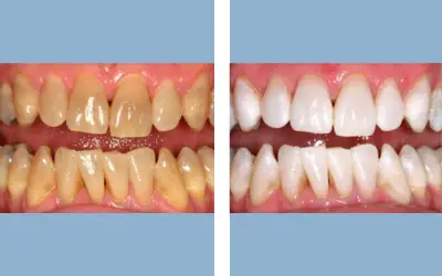 Teeth whitening before and after result 6 - dental treatment in India, IndiCure patient