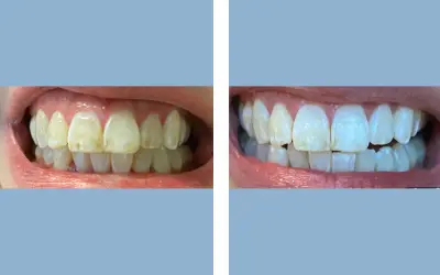 Teeth whitening before and after result 7 - dental treatment in India, IndiCure patient
