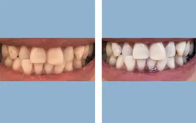 Teeth whitening before and after result 8 - dental treatment in India, IndiCure patient