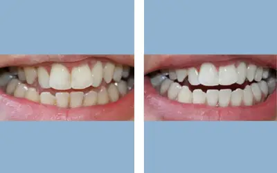Teeth whitening before and after result 9 - dental treatment in India, IndiCure patient