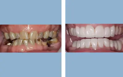 Tooth crown before and after result 1 - dental crown treatment in India, IndiCure patient