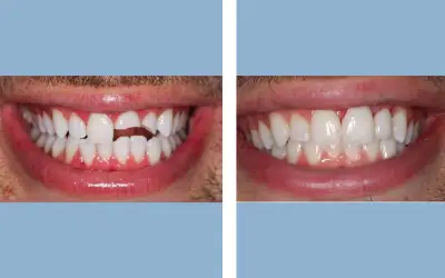 Tooth crown before and after result 2 - dental crown treatment in India, IndiCure patient