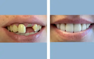 Tooth crown before and after result 3 - dental crown treatment in India, IndiCure patient