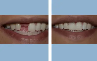 Tooth crown before and after result 4 - dental crown treatment in India, IndiCure patient