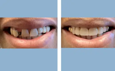 Tooth crown before and after result 5 - dental crown treatment in India, IndiCure patient
