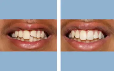 Tooth crown before and after result 6 - dental crown treatment in India, IndiCure patient