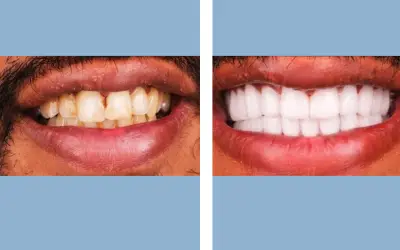 Tooth crown before and after result 7 - dental crown treatment in India, IndiCure patient