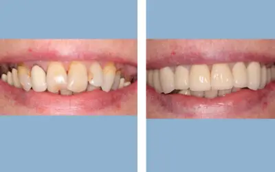 Tooth crown before and after result 8 - dental crown treatment in India, IndiCure patient