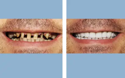Tooth crown before and after result 9 - dental crown treatment in India, IndiCure patient