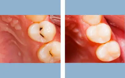 Tooth filling before and after result 1 - dental restoration in India, IndiCure patient