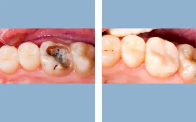 Tooth filling before and after result 2 - dental restoration in India, IndiCure patient