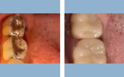 Tooth filling before and after result 3 - dental restoration in India, IndiCure patient