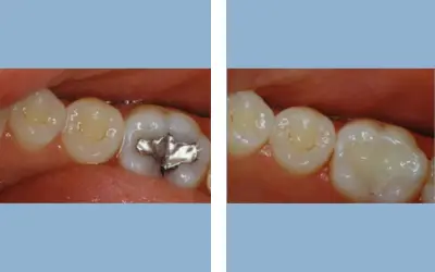 Tooth filling before and after result 4 - dental restoration in India, IndiCure patient