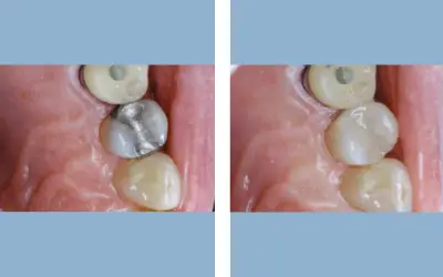 Tooth filling before and after result 5 - dental restoration in India, IndiCure patient