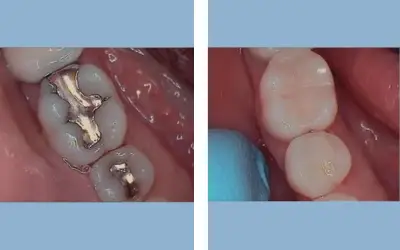 Tooth filling before and after result 6 - dental restoration in India, IndiCure patient