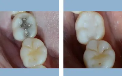 Tooth filling before and after result 7 - dental restoration in India, IndiCure patient