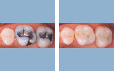 Tooth filling before and after result 8 - dental restoration in India, IndiCure patient