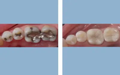 Tooth filling before and after result 9 - dental restoration in India, IndiCure patient