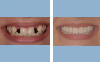 Tooth implant before and after result 1 - dental implant treatment in India, IndiCure patient