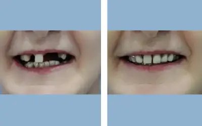 Tooth implant before and after result 10 - dental implant treatment in India, IndiCure patient