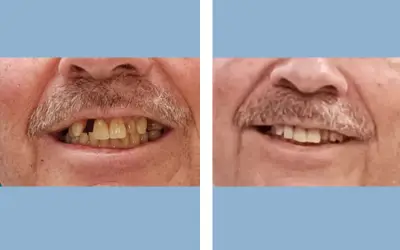 Tooth implant before and after result 11 - dental implant treatment in India, IndiCure patient