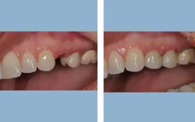 Tooth implant before and after result 2 - dental implant treatment in India, IndiCure patient