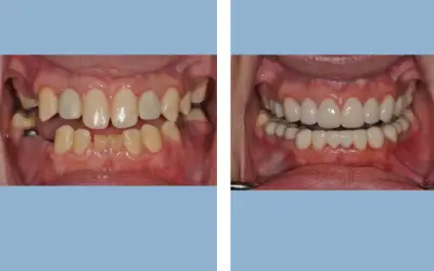 Tooth implant before and after result 3 - dental implant treatment in India, IndiCure patient
