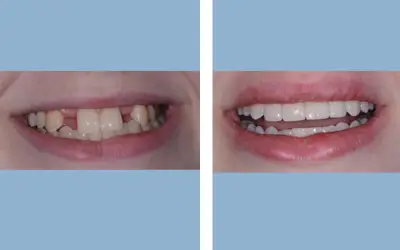 Tooth implant before and after result 4 - dental implant treatment in India, IndiCure patient